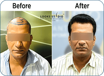 Hair Transplant Result 1