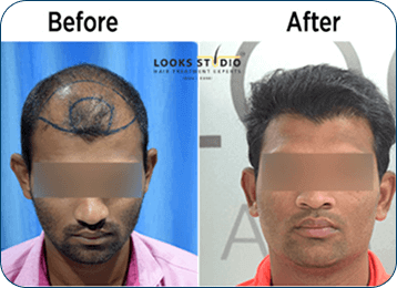 Hair Transplant Result 2