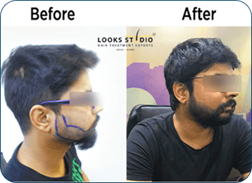 Hair Transplant Result 3
