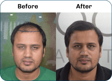Hair Transplant Result 4