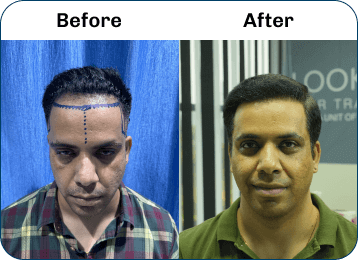 Hair Transplant Result 5