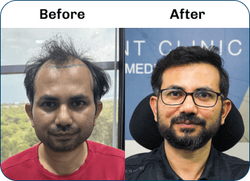 Hair Transplant Result 6
