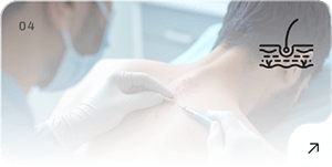 Body to Head Hair Transplant