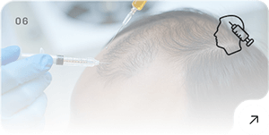 GFC Treatment