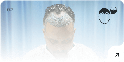 Premium Hair Transplant
